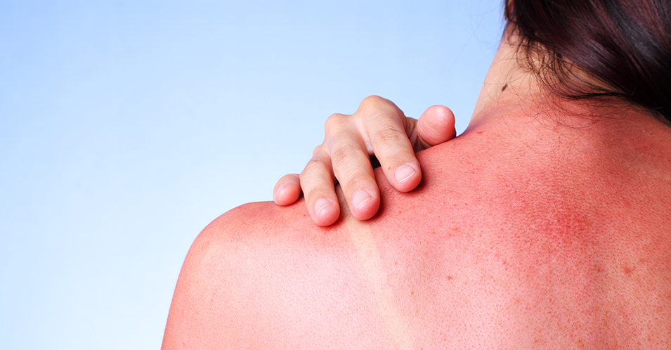 Come abbronzarsi in sicurezza: stop alle scottature solari in 8 passi